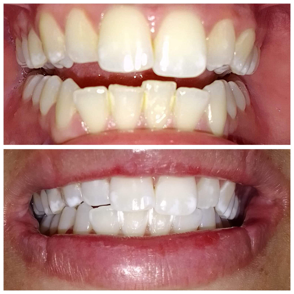 Teeth Whitening Training - Face-to-face or Videoconference